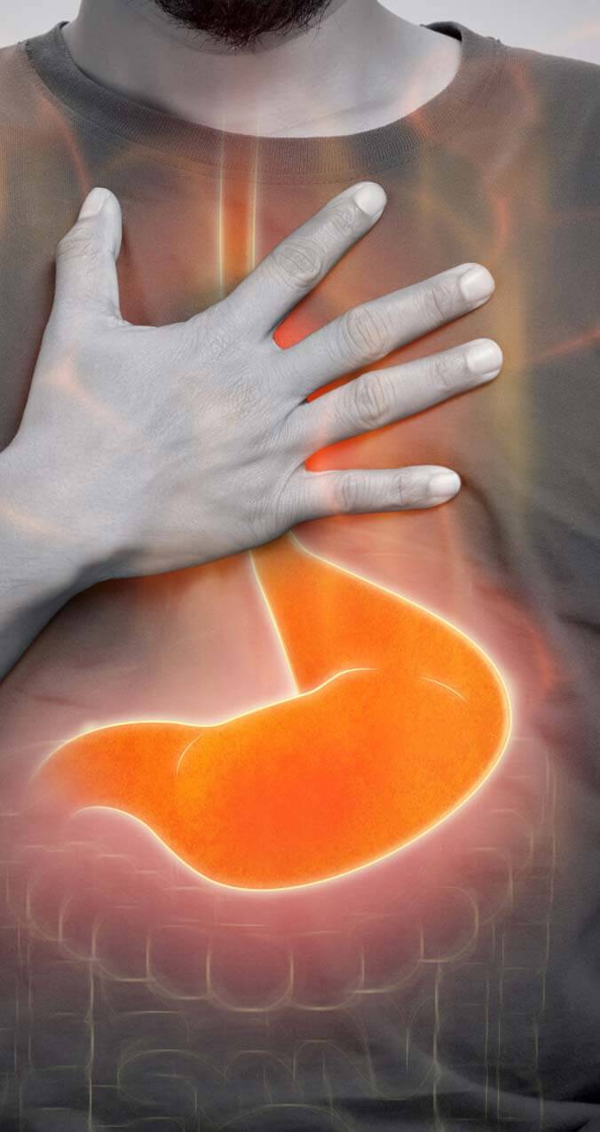 Acid Reflux
